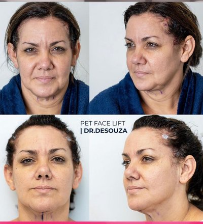 Beautiful immediate results !! PET Face Lift tech…