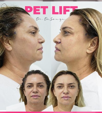 A younger you!! PET Face Lift by 👨‍⚕️ Dr.DeSouza …
