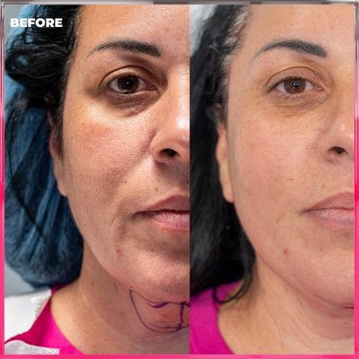 Immediate results !! PET Face Lift with Chin Lipo…